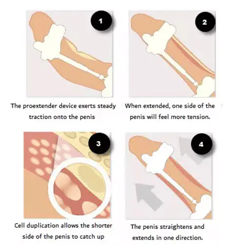 Passionate Pro Extender Penis Enlargement System